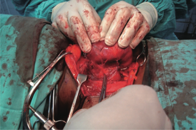 Figure 1. Securing the thyroid vessels early by ligation before gland excision.