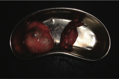 Figure 2. Right (larger) and left lobes of thyroid gland excised with minimal blood loss.