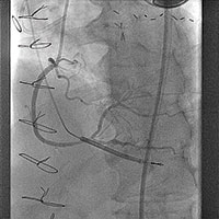 chronic-total-occlusion-1