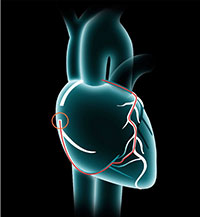 revascularization-cvp