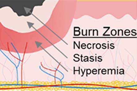 burn zones: necrosis, stasis, and hyperemia