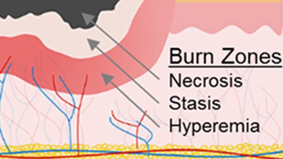Device for the Prediction of Burn Wound Conversion MedStar Health