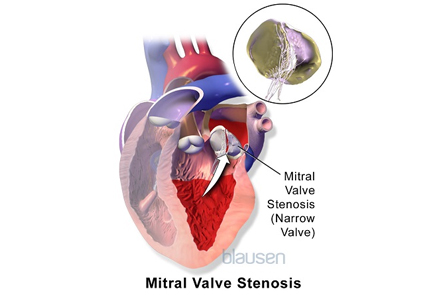 Image of a heart and mitral valve stenosis