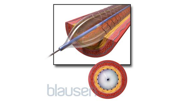 3d illustration of vascular stents