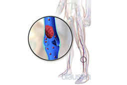 3d illustration of deep vein thrombosis