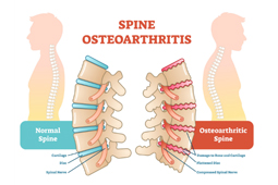 Spine osteoarthritis infographic