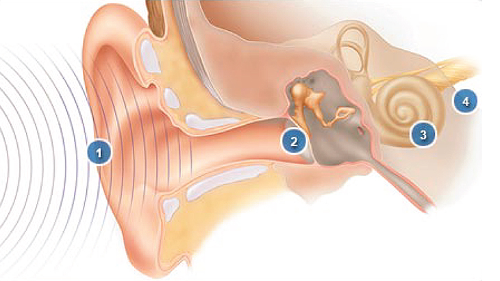 image of a Cochlear Implant