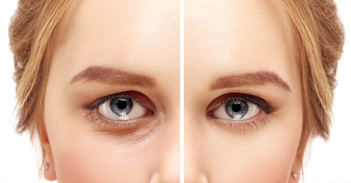 Facial Fat Grafting MedStar Health