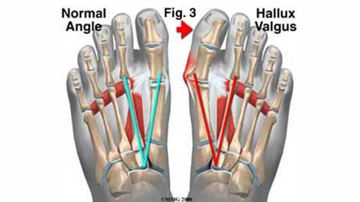 Graphic of feet showing a normal angle and a Hallux Valgus prior to a Bunionectomy