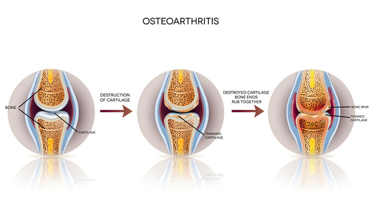 Osteoarthritis Diagram: A closer look at degenerative joint disorder