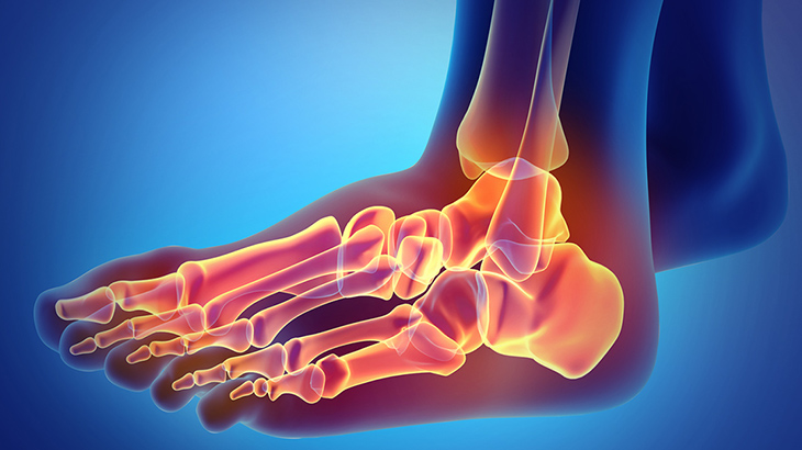 x-ray of an arthritic foot