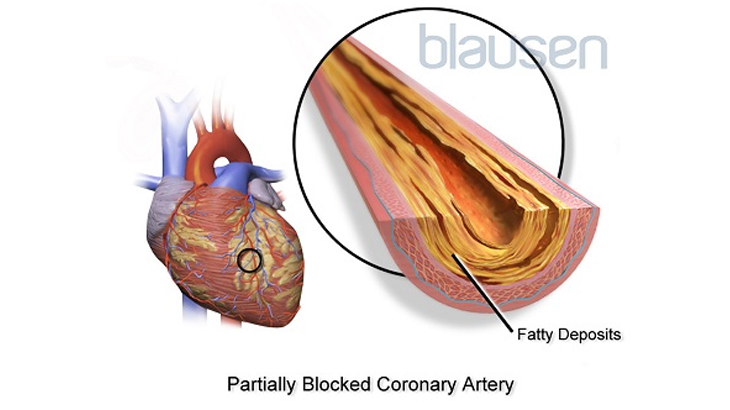 Image shows the inside view of a partially blocked coronary artery that has layers of fatty deposits as well as where on the heart this artery can be found.