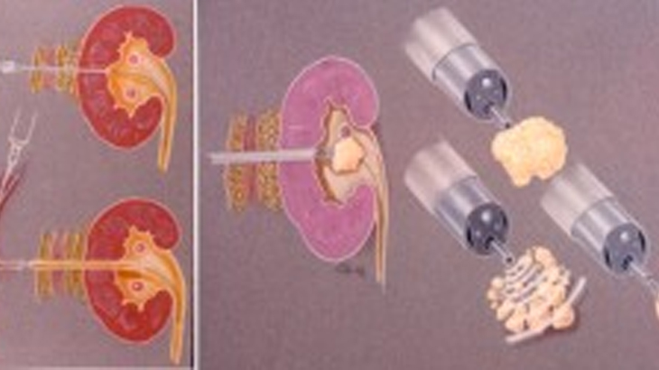 Percutaneous Nephrolithotomy