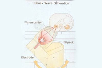 Shock Wave Generation