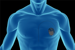 Graphic of a male torso with a pacemaker in the heart