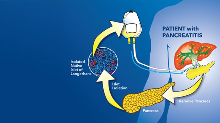 Pancreatic Autologous Islet Cell Transplant | MedStar Health
