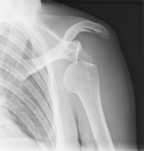 Dislocated shoulder x-ray